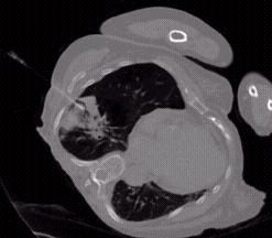 Cat-Scan (CT) guided lung biopsy image