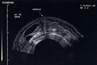 Panoramic ultrasound of the breast showing proliferative breast disease and the lateral predominance of multiple cysts