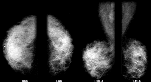 The patient's mammogram shows