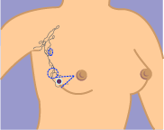 What is a partial mastectomy?