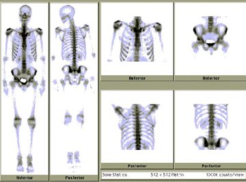 Bone Scan Spine