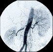 Conventional angiogram of descending aorta, kidneys and renal arteries