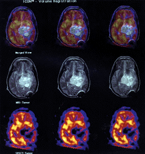 A nuclear medicine and MRI scan combination image for research