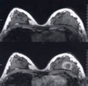 Transverse fast acquisition breast MRI images