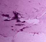 Pathology image of a breast biopsy specimen