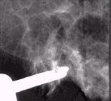 Mammogram image showing positioning