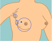 Modified Radical Mastectomy