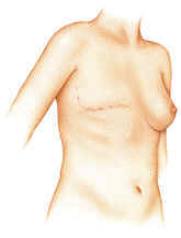 Post-mastectomy scar