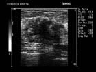 Solid irregular breast mass with calcification (calcium deposits)