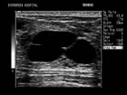 Breast cyst. Image shows sharp cystic walls and internal septation by cyst membrane.