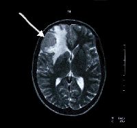 MR image of head showing disease in brain