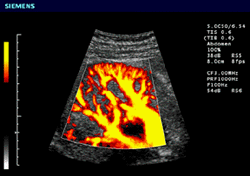 Colorized ultrasound of a kidney