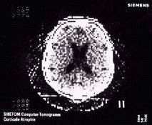 Brief History Of Ct Ct Scan Imaginis The Women S Health Wellness Resource Network