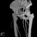 CT 3-D reconstruction of femoral arteries