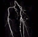 CT angiogram of the femoral arteries