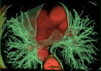 3D Virtual Reality CT Image of Lungs and Heart