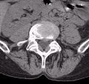 CT image of the lumbar spine showing a prolapsed disk