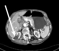 CT image of abdomen showing a cyst in the right kidney
