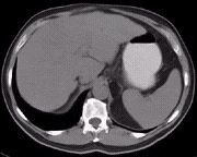 CT scan of the liver without contrast