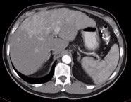 CT scan of the liver with contrast