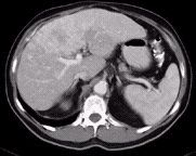CT scan of the liver with washed out contrast