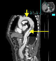 CT image of aortic aneurysm (arrows)