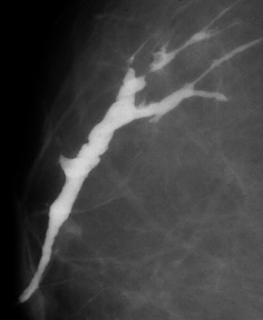 X-ray mammogram showing ducts outlined with contrast