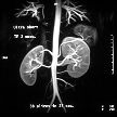 MR Angiogram of the kidneys and aorta