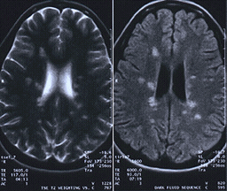 MRI images showing multiple sclerosis