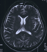 MRI image of MS