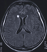 MRI image showing MS as white dot