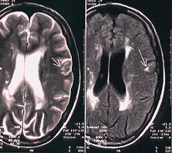 MRI images of MS in brain