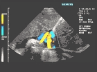 Ultrasound image of umbilical cord