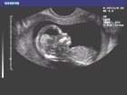 Ultrasound image of intracranial anatomy and facial features