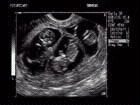 Panoramic ultrasound image of triplet gestation at 11 weeks