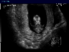 3D ultrasound image of fetal orbits (eye sockets) at 12 weeks