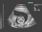 Ultrasound image of 11-12 week fetus shows division of hemispheres and choroid plexus