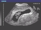 Ultrasound image of first trimester embryo and yolk sac