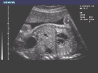 Ultrasound image of fetal liver/lung interface