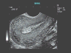 Ultrasound image of vascular changes in the uterus