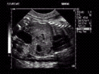 Ultrasound image of fetal bladder, stomach, heart and the liver/lung interface