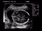 Ultrasound image of fetal intracranial structures including cerebellum