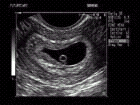 Ultrasound image of yolk sac and fetal pole at 6 week gestation