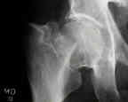 Xray of fractured femoral neck