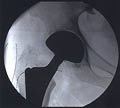 Hip Prosthesis X-ray