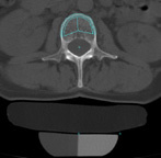CT Scan bone density analysis