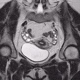 MRI of female pelvis showing the ovaries and bladder