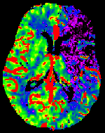 Colorized CT image of the brain showing the signs of a stroke (in purple)