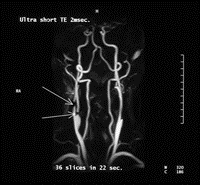MR Angiogram showing a narrowing of the carotid artery (arrows)
