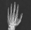 X-ray of hand